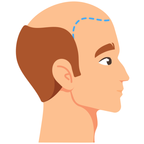 Bald Spot Treatments