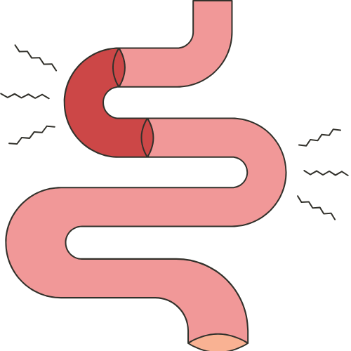 Gastric Bypass Surgery