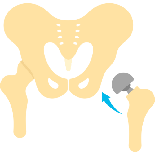 Joint Replacement Surgery
