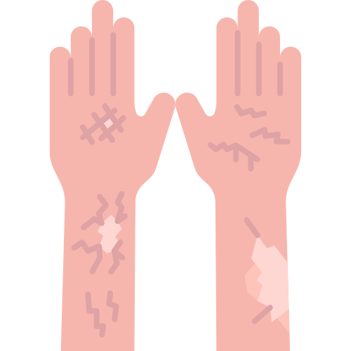 Sclerotherapy