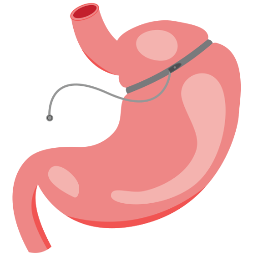 Gastric Banding