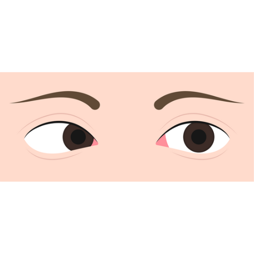 Strabismus Treatment
