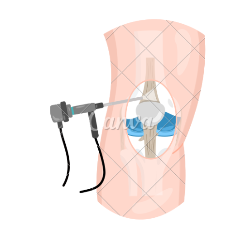 Arthroscopy