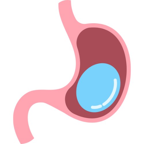 Gastric Balloon
