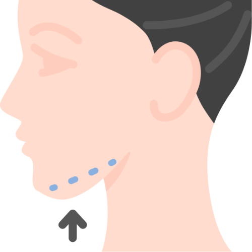 Chin Augmentation