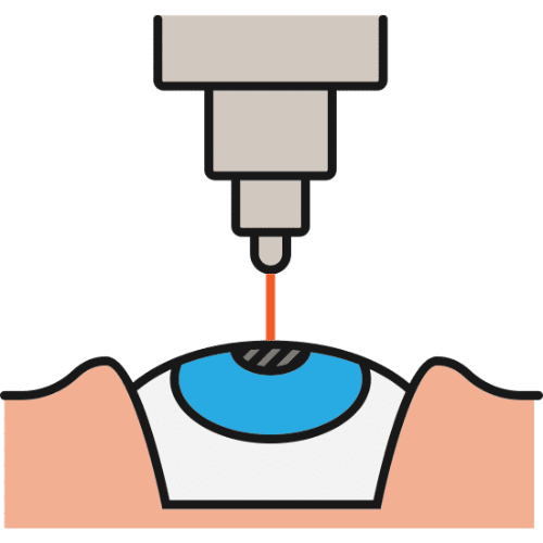 Laser Eye Surgery