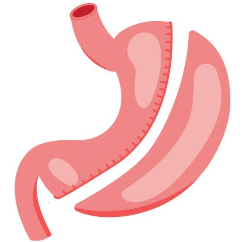 Gastric Sleeve Surgery