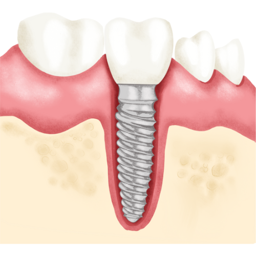 Sinus Lift